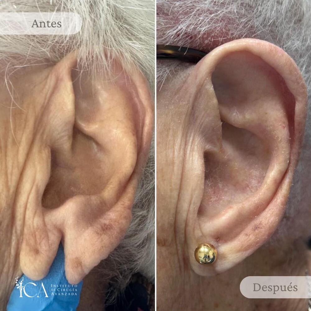 Before and After Result